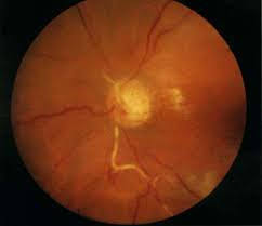 retinal artery occlusions kirby eye