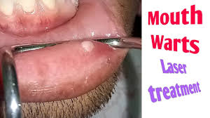 mouth wart removed with lasers