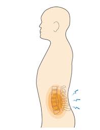 what is lumbar disc herniation sciatica