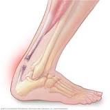 Image result for icd 10 code for achilles rupture