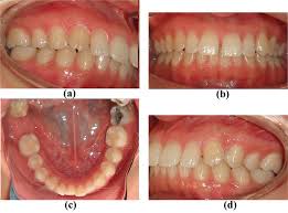 It's estimated that around 50 percent of undesired shifting occurs within 2 years after a patient stops wearing a retainer. Orthodontic Management Of Residual Spaces Of Missing Molars Decision Factors Intechopen