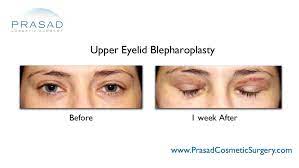 upper eyelid surgery