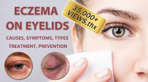 eczema on eyelids 2022 2023 causes