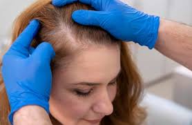 hair loss during menopause causes