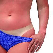 Sunburn Treatment After Sun Skin Care