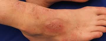 treat eczema and dry skin winter itch