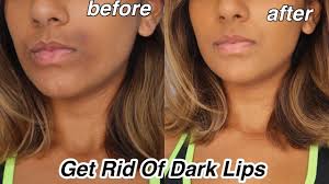 how to get rid of dark lips and