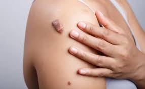 keloid scar removal in singapore dr
