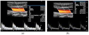 ultrasound vector flow imaging