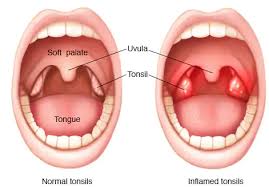 tonsillitis fact sheet emergency care