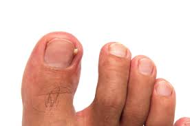 ingrown toenail troubles bay