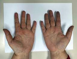 好醫師新聞網- OL手指如瘀青竟是罕見雷諾氏症