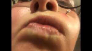 monroe lip piercing embedded into
