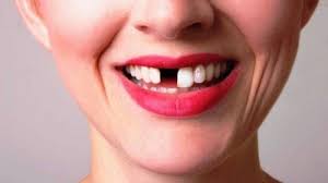 Jika bemimpi gigi sebelah atas tanggal atau sakit. 6 Arti Mimpi Gigi Copot Tak Selalu Menjadi Pertanda Kematian Tapi Bisa Jadi Pertanda Lain Tribun Jogja