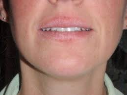 recur lip rashes cheilitis