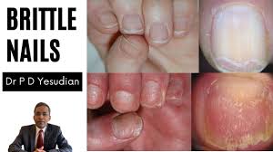 brittle nails causes and treatment