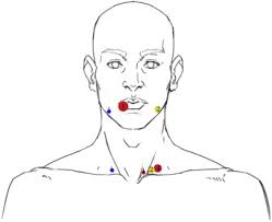 supraclavicular lymph node recurrence