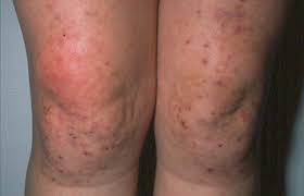 celiac and your skin dermais