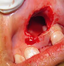 treatment of a large maxillary cyst