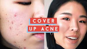 how to cover up acne my secret to