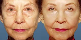 Image result for facial rejuvenation acupuncture before and after