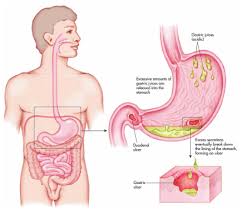 peptic ulcer causes symptoms t