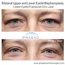 under eye wrinkle treatment options
