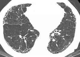 Sections interstitial (nonidiopathic) pulmonary fibrosis. Fibrosis Pulmonar Idiopatica Trastornos Pulmonares Manual Msd Version Para Profesionales