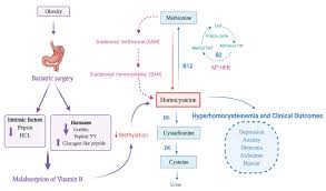 bariatric surgery on vitamin b