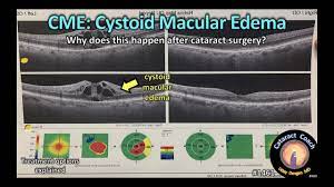 cystoid macular edema cme