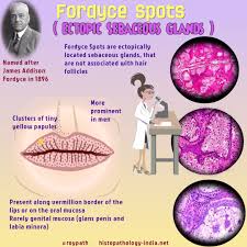 pathology of fordyce spots ectopic