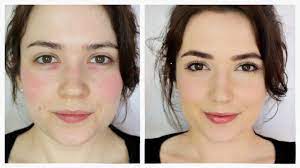 how to cover rosacea redness you
