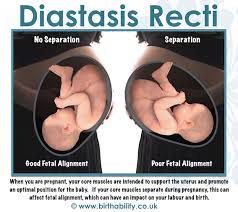 Your pelvic floor is an important part of the abdominal system. Diastasis Recti What Does It Mean For Pregnant And Postnatal Women Birthability