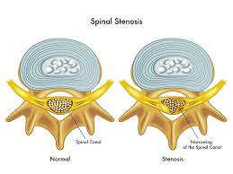 spinal stenosis minnesota spine insute