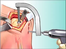 left humeral intramedullary nailing