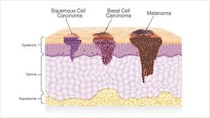 skin cancer types and their features