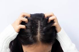 how to remove dandruff with natural