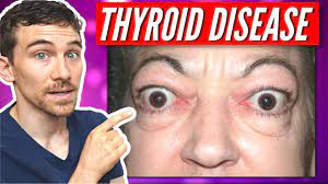 thyroid eye disease and graves disease