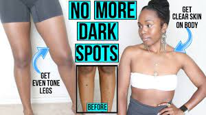 dark spots on legs body fast