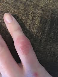 Some of the symptoms which may suggest a broken pinky finger or pinky finger fracture are severe pain in the pinky finger along with swelling and tenderness in the area. Container You Deal With Your Key Authority Over On The Way To Your Pinky Pain In Joints Of Pinky Finger