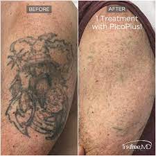 Each laser tattoo removal patient should expect unique results based on a number of independent factors: Tattoo Removal Inkfree Md Laser Clinic Houston Tx
