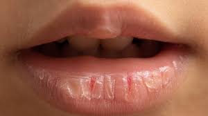 know why lips get dry in winters we