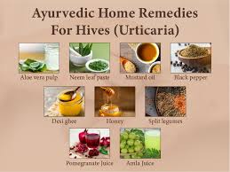 ayurvedic home remes for hives