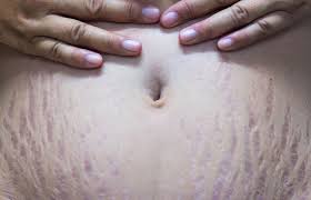 red stretch marks causes treatments