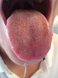 Mundsoor entsteht, wenn sich der candida pilz in der mundschleimhaut ansammelt. Komische Fussel Auf Zunge Mundsoor Medizin Krankheit Mund
