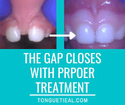 lip tie help close a gap in the teeth