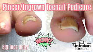 cure pincer toenails