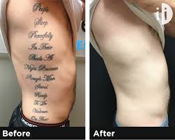 Whether you use a specific cream for tattoo removal, like wrecking balm, or a lightening cream, like skin doctors sd white, you will end up spending a lot on these products before you see some fading. Los Angeles Tattoo Removal Laser Tattoo Removal In Los Angeles