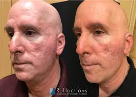 acne scars treated with rf