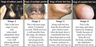 alopecia areata treatment in bangalore